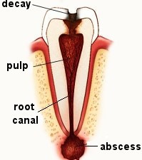 آبسه دندان،periapical abscess